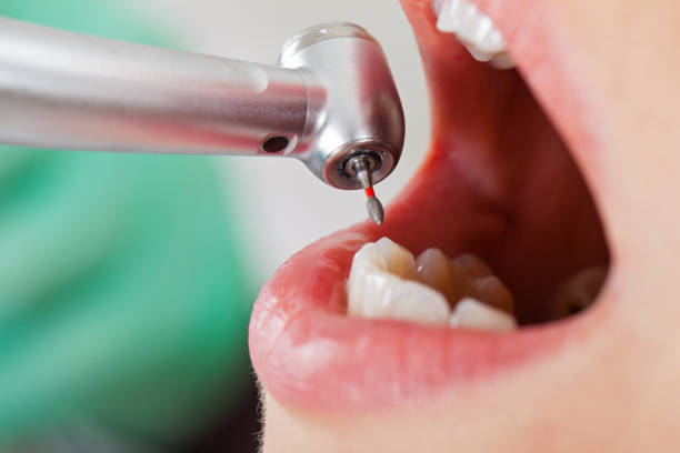 Best Emergency Root Canal Treatment in Waterman, IL